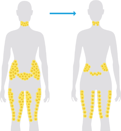 Fonte graisseuse du corps par cryolipolyse Coolsculpting