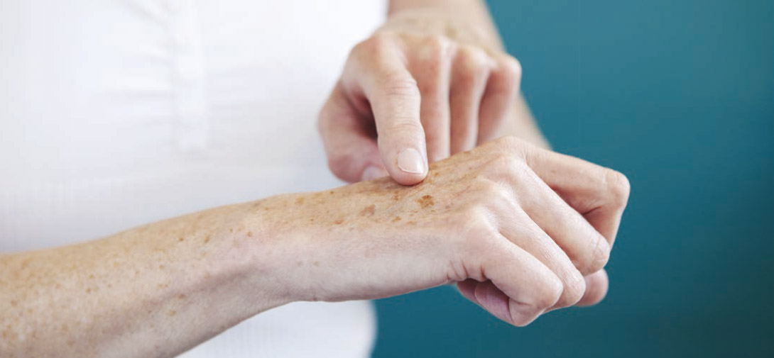 Les taches pigmentaire des mains : une indication fréquente pour un traitement au laser