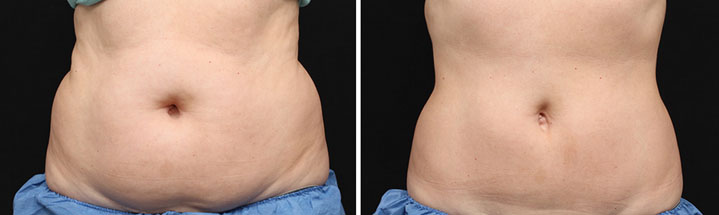 Photo avant après traitement abdomen par Coolsculpting