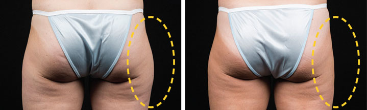 Photo avant après traitement culotte de cheval par Coolsculpting