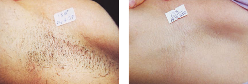 Epilation laser à Wasquehal près de Lille et Roubaix Dr Chebani