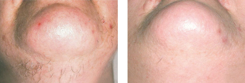 Photo avant et après épilation laser du menton