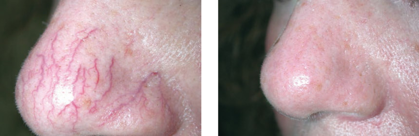 Photo avant et après traitement de varicosités sur le nez au laser GentlePro
