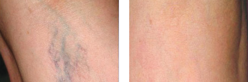 Photo avant et après traitement de varicosités sur les jambes au laser GentlePro
