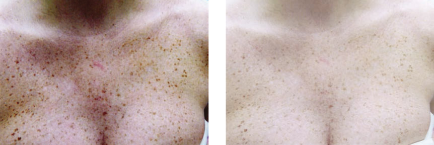 Photo avant et après traitement des taches du décolleté au laser pigmentaire Gentle Pro